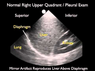 Ultrasound Detection of Pleural Fluid - SonoSite, Inc.